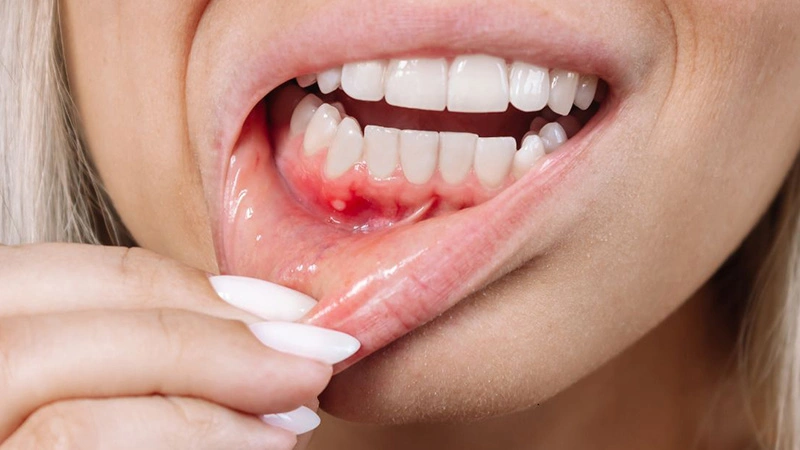 redness, bleeding, swelling